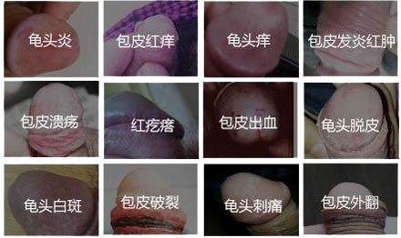 台江医院 泌尿男科 生殖器感染  包皮红疙瘩痒是不是性病?